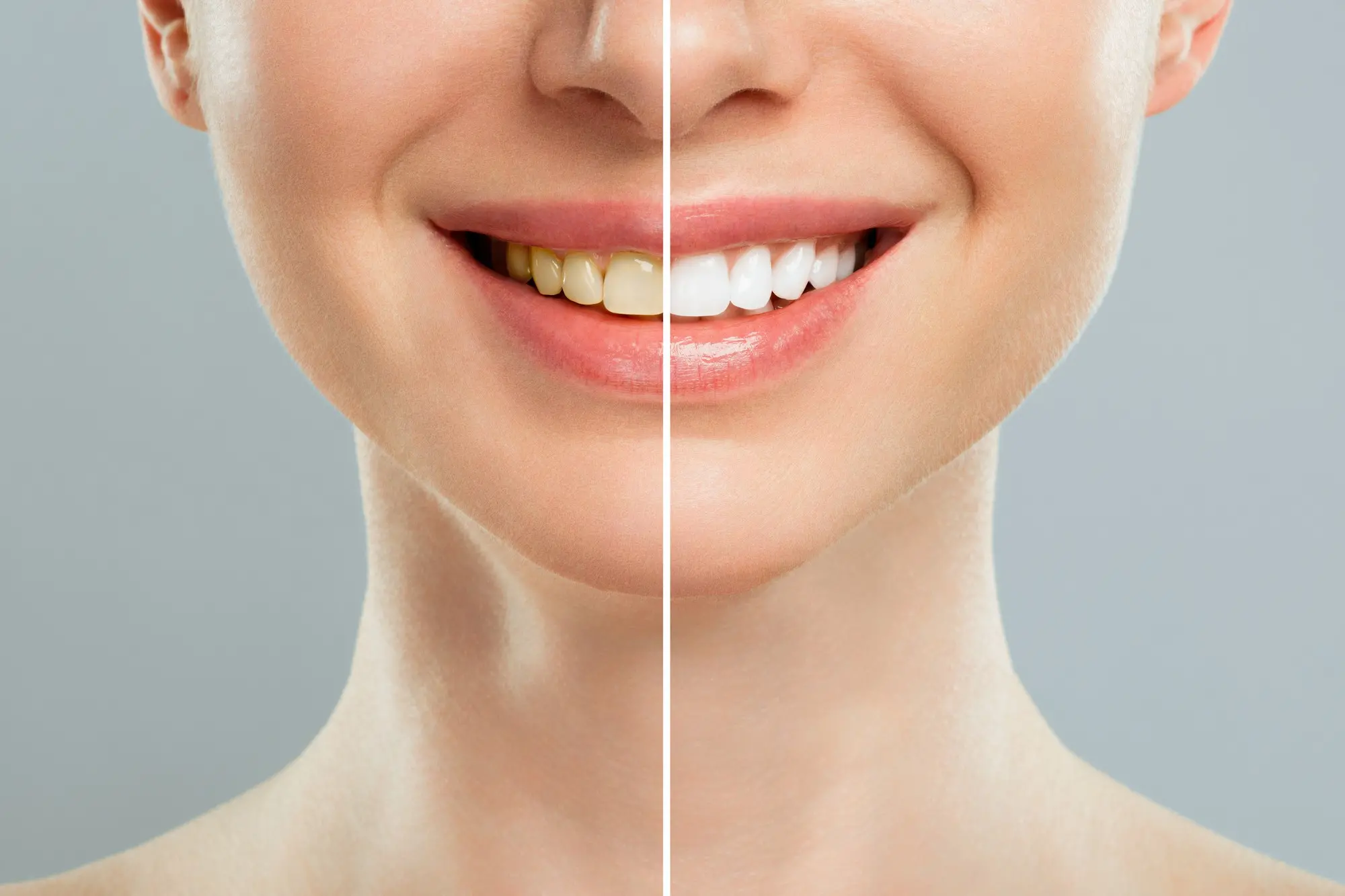 dientes antes y después de tratamiento de limpieza